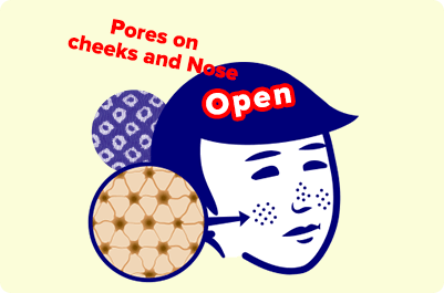 Open　Pores on cheeks and Nose
