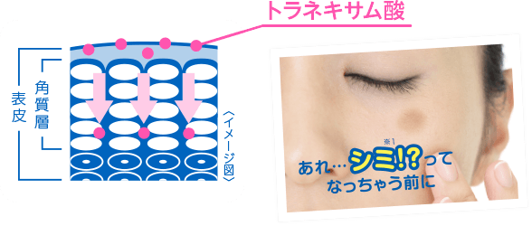 トラネキサム酸 あれ・・・シミ!?ってなっちゃう前に