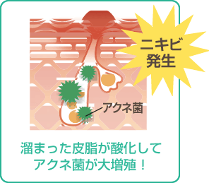 ニキビ発生 アクネ菌 溜まった皮脂が酸化してアクネ菌が大増殖！