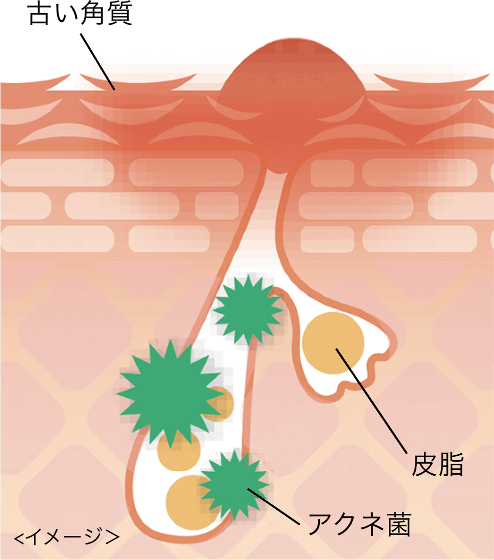 イメージ　古い角質　皮脂　アクネ菌