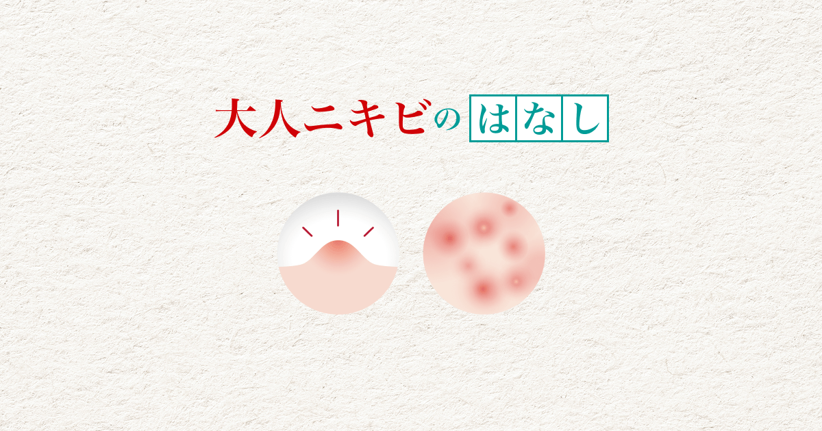 アクネバリア 大人ニキビのはなし｜ニキビ予防・ニキビ対策｜石澤研究