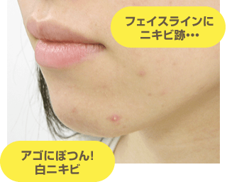 フェイスラインにニキビ跡… アゴにぽつん！白ニキビ