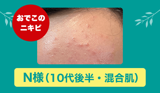 アクネバリア 大人ニキビ 本気の1ヵ月モニター報告（N様）