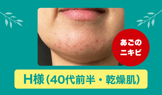 アクネバリア 大人ニキビ 本気の1ヵ月モニター報告（H様）