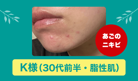アクネバリア 大人ニキビ 本気の1ヵ月モニター報告（K様）