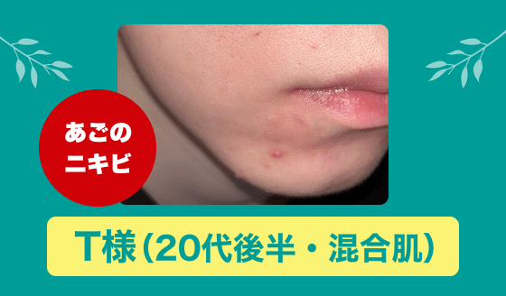 アクネバリア 大人ニキビ 本気の1ヵ月モニター報告（T様）