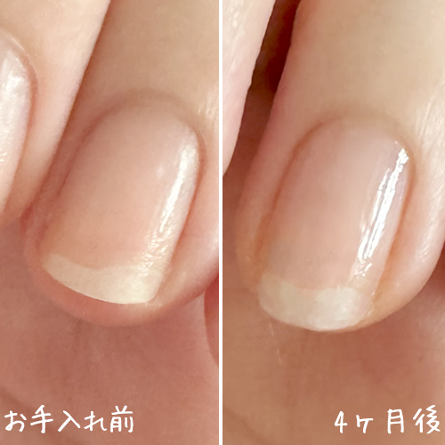 1ヶ月→4ヶ月検証】ハイポニキウムの保湿ケアを続けてみた！保湿オイル