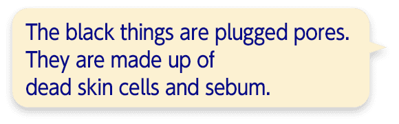 The black things are plugged pores. They are made up of dead skin cells and sebum.