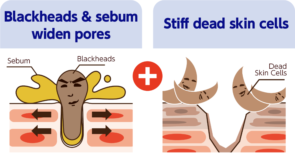 Blackheads & sebum widen pores