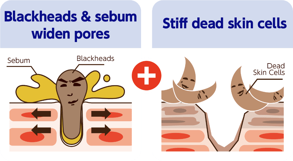 Blackheads & sebum widen pores