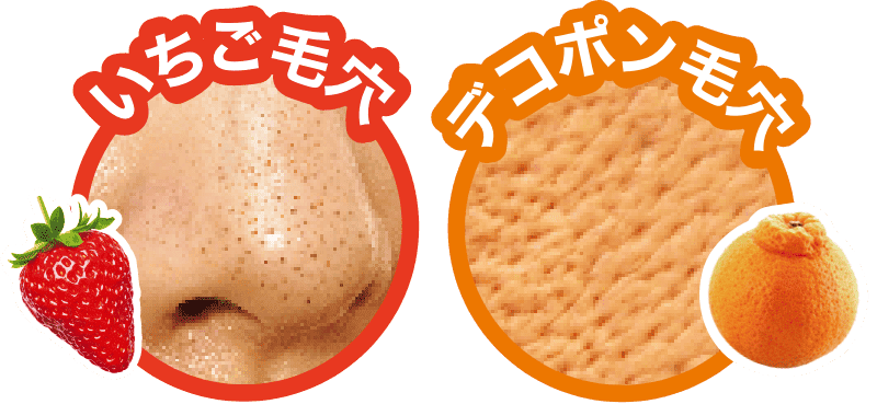 いちご毛穴とデコポン毛穴