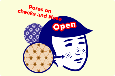 Open Pores on cheeks and Nose