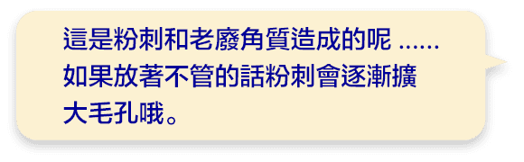 這是粉刺和老廢角質造成的呢......如果放著不管的話粉刺會逐漸擴大毛孔哦。