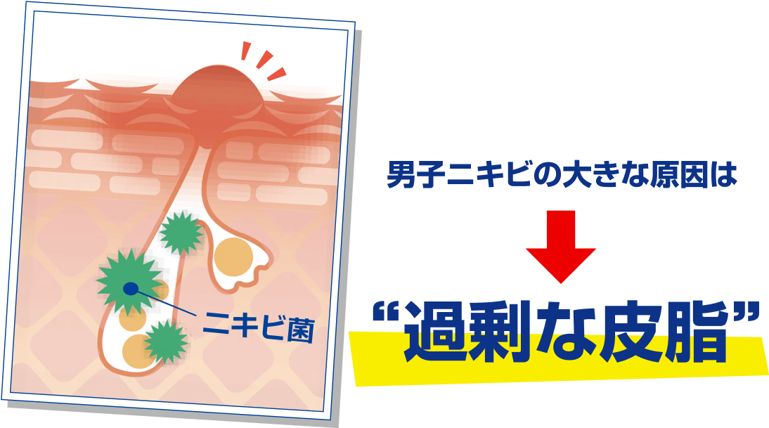 男子ニキビの大きな原因は 過剰な皮脂