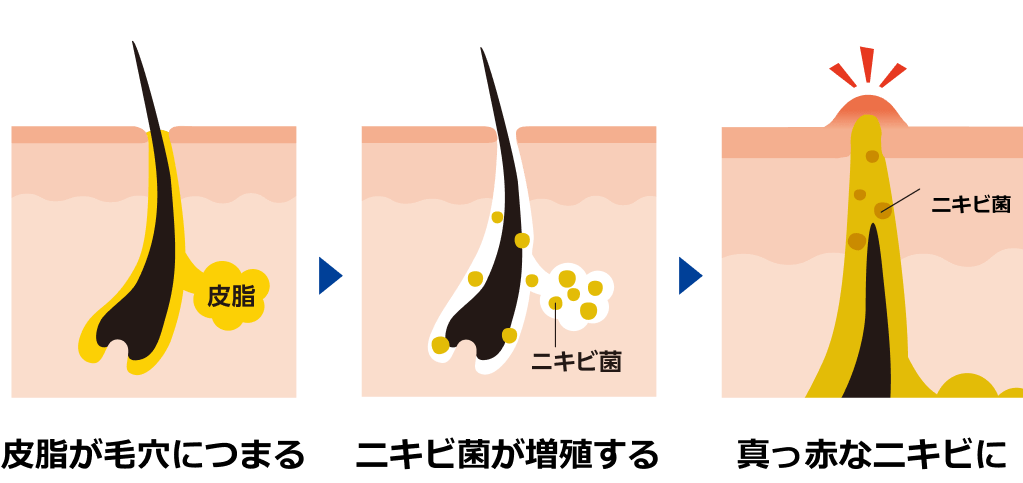 皮脂が毛穴につまる ニキビ菌が増殖する 真っ赤なニキビに