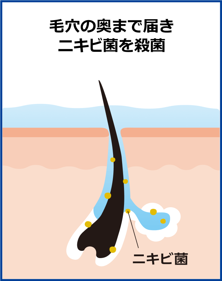毛穴の奥まで届きニキビ菌を殺菌
