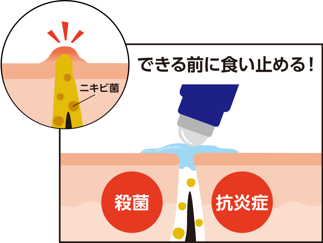 できる前に食い止める！ 殺菌 抗炎症