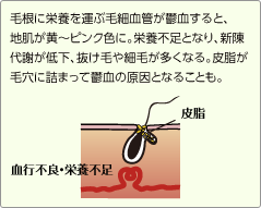 毛根に栄養を運ぶ毛細血管が鬱血すると、地肌が黄～ピンク色に。栄養不足となり、新陳代謝が低下、抜け毛や細毛が多くなる。皮脂が毛穴に詰まって鬱血の原因となることも。