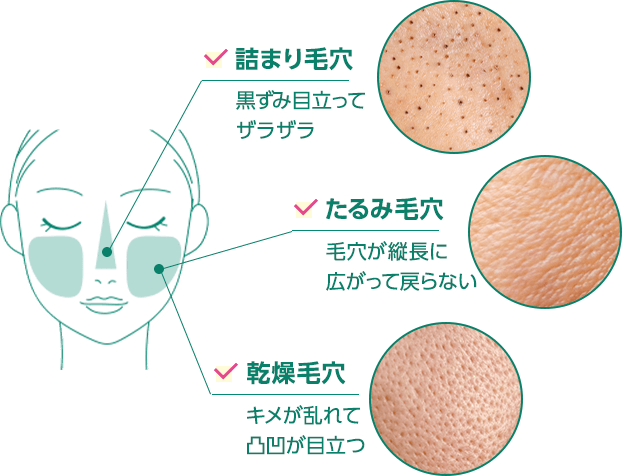 詰まり毛穴 黒ずみ目立ってザラザラ　たるみ毛穴 毛穴が縦長に広がって戻らない　乾燥毛穴 キメが乱れて凸凹が目立つ