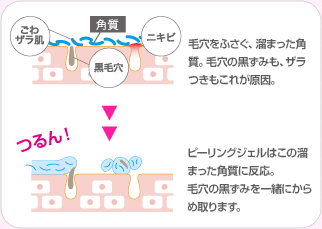 毛穴をふさぐ、溜まった角質。毛穴の黒ずみも、ザラつきもこれが原因。ピーリングジェルはこの溜まった角質に反応。毛穴の黒ずみを一緒にからめ取ります。